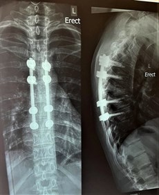 Cornish has a lot to recover from ... the Xray after major back surgery (above) ... and before (below)